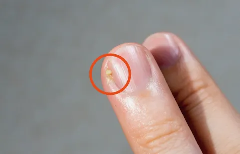 ひょう疽（爪囲炎）の症例画像。爪の横に膿がたまっている状態