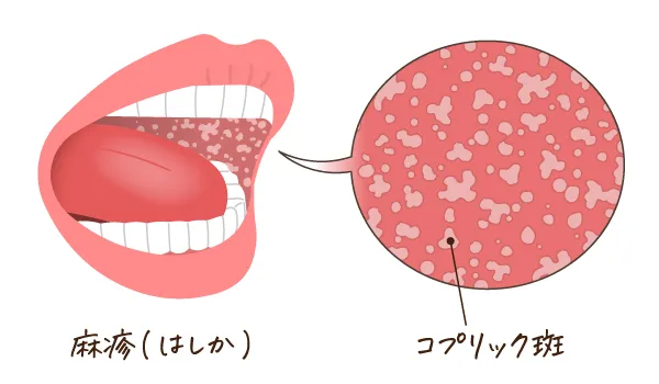 麻疹：コプリック斑（はん）が出ているイラスト