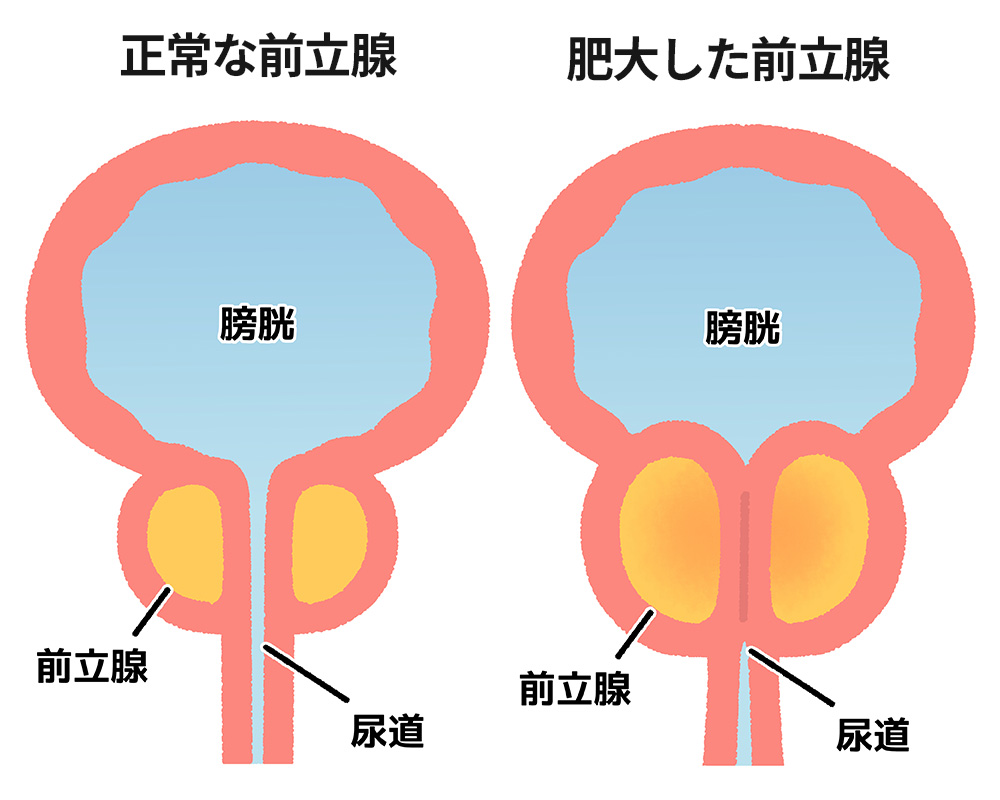 正常な前立腺と肥大した前立腺の図解