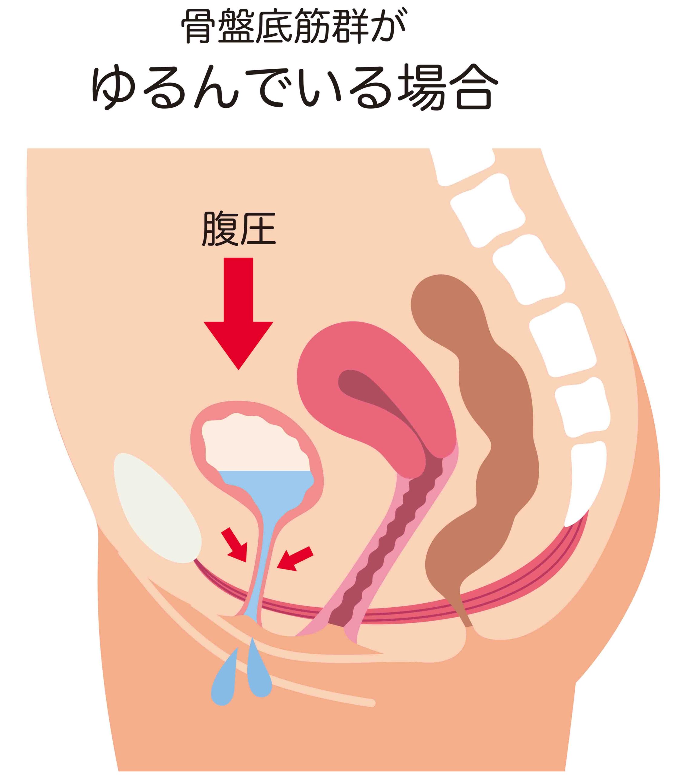 骨盤底筋群が緩んで、頻尿になっているイラスト