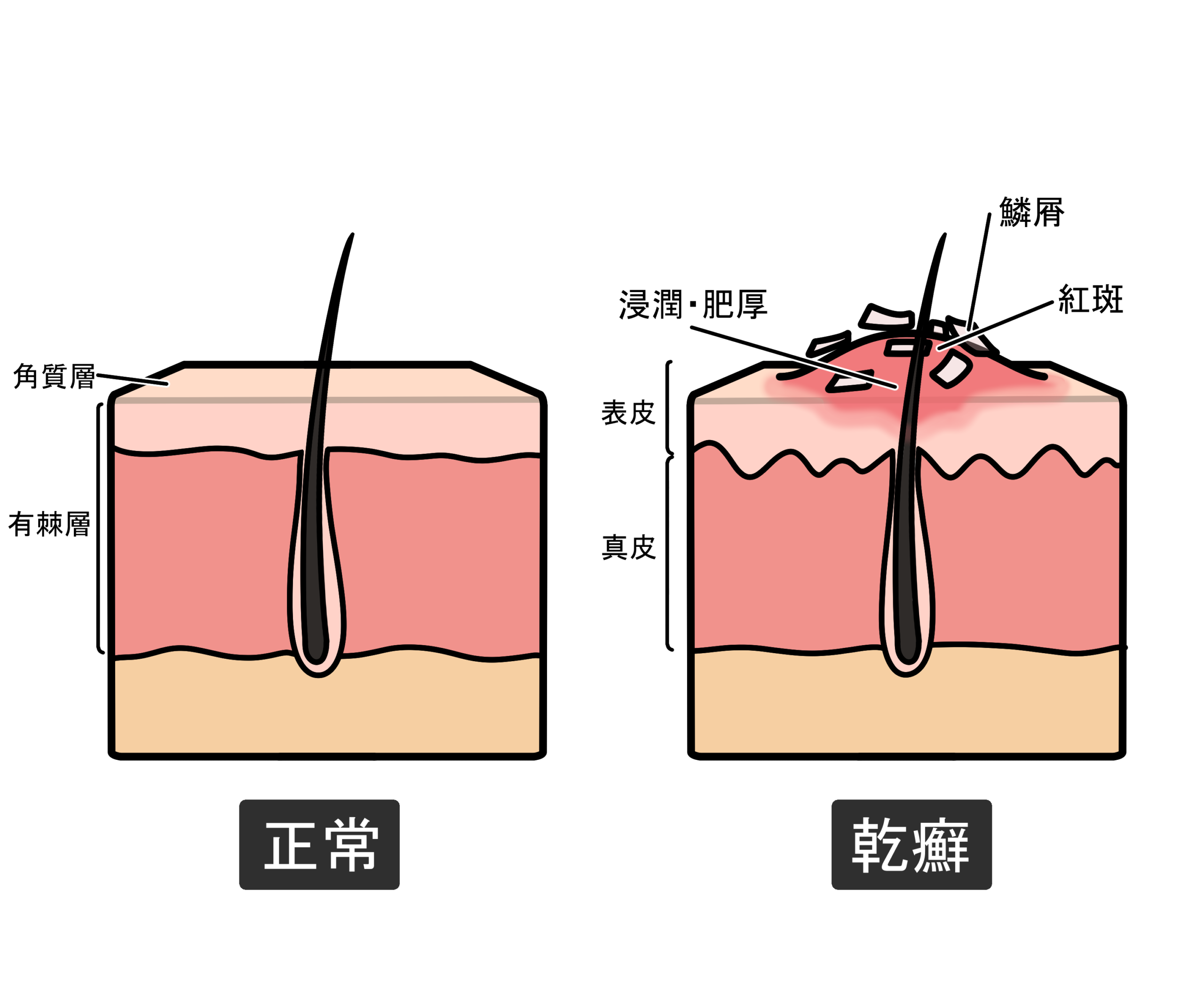 正常な皮膚と乾癬を患っている皮膚の比較断面イラスト