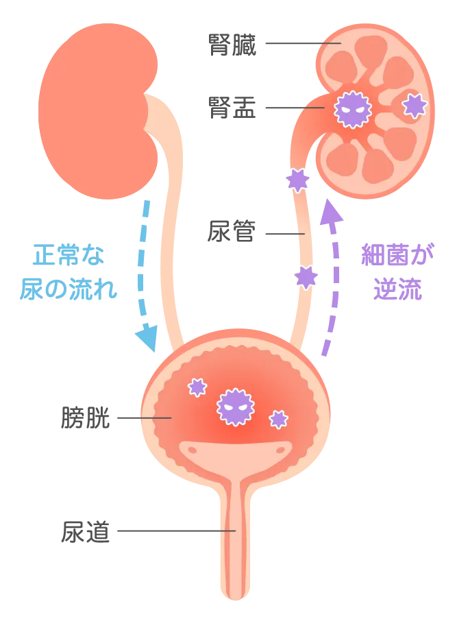 膀胱炎から腎盂腎炎への悪化（上行性感染）の仕組みを表したイラスト図解（細菌の逆流）