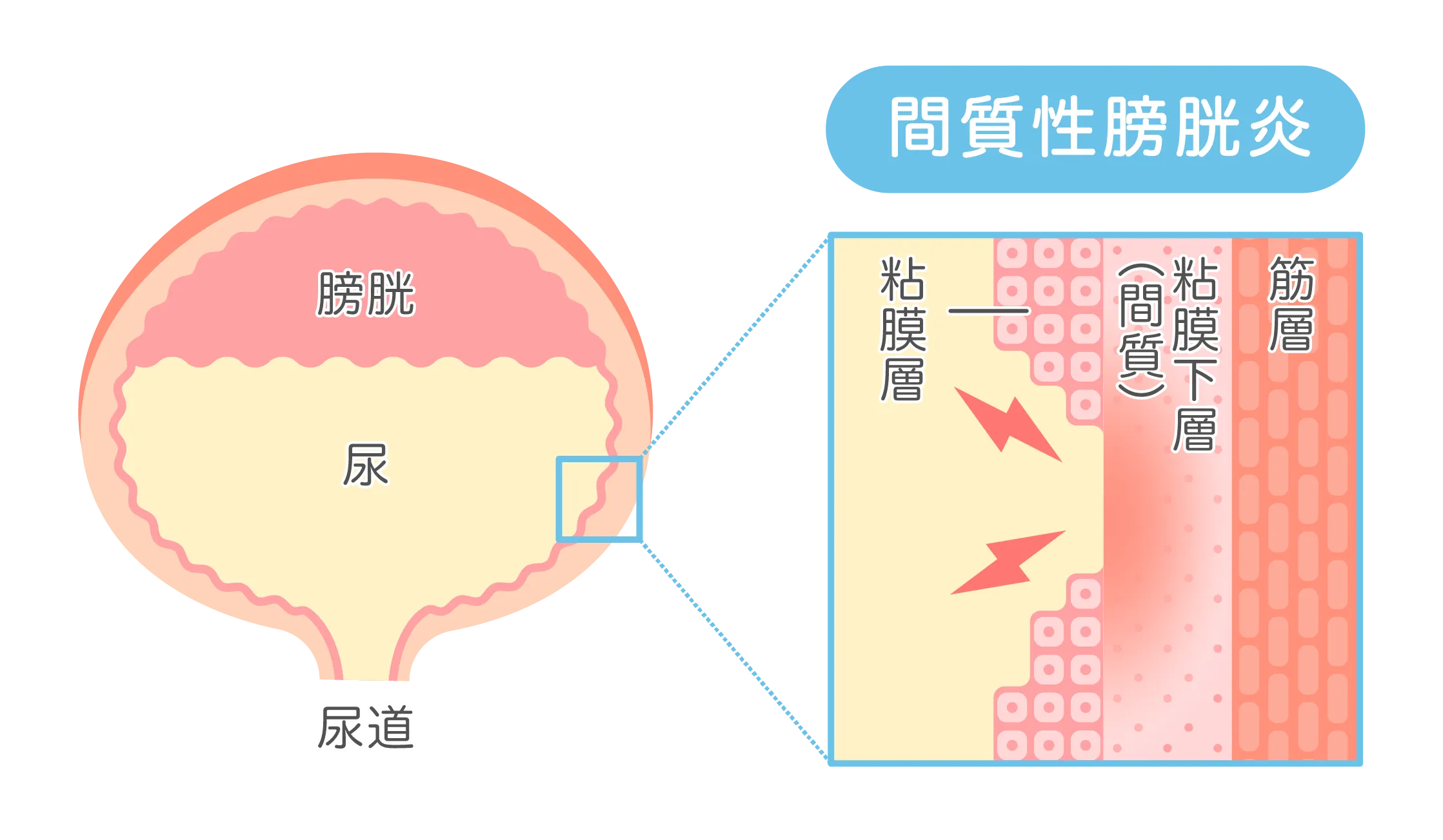 間質性膀胱炎の仕組みを表したイラスト図解（膀胱粘膜の下層・間質部分の炎症）