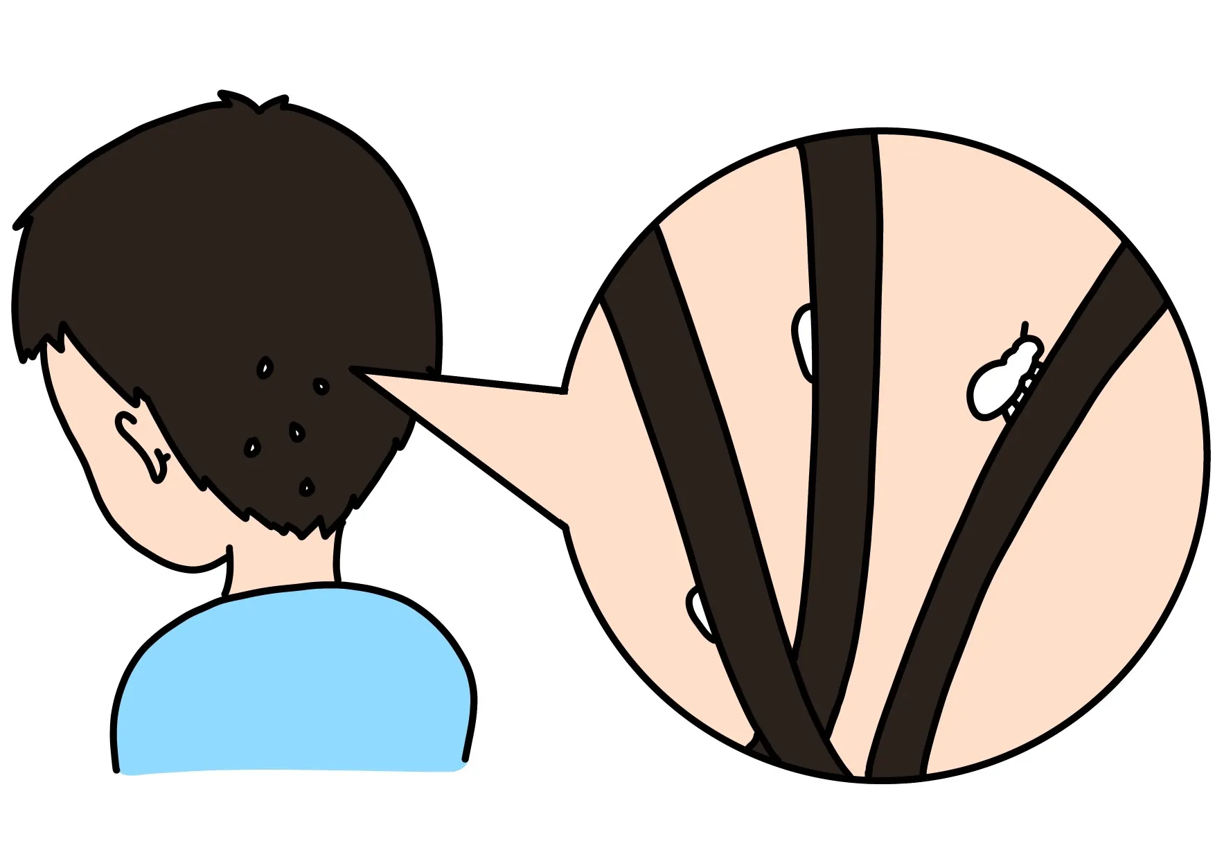 頭にシラミがある男児のイラスト