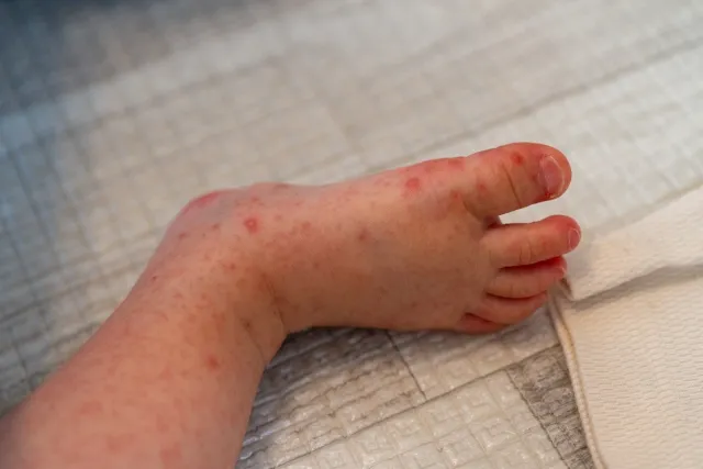 子供の足の裏や甲に現れた手足口病の典型的な赤い発疹