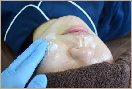 ケミカルピーリングの施術手順 STEP4：施術後のヘパリン軟膏による仕上げの保湿剤塗布風景