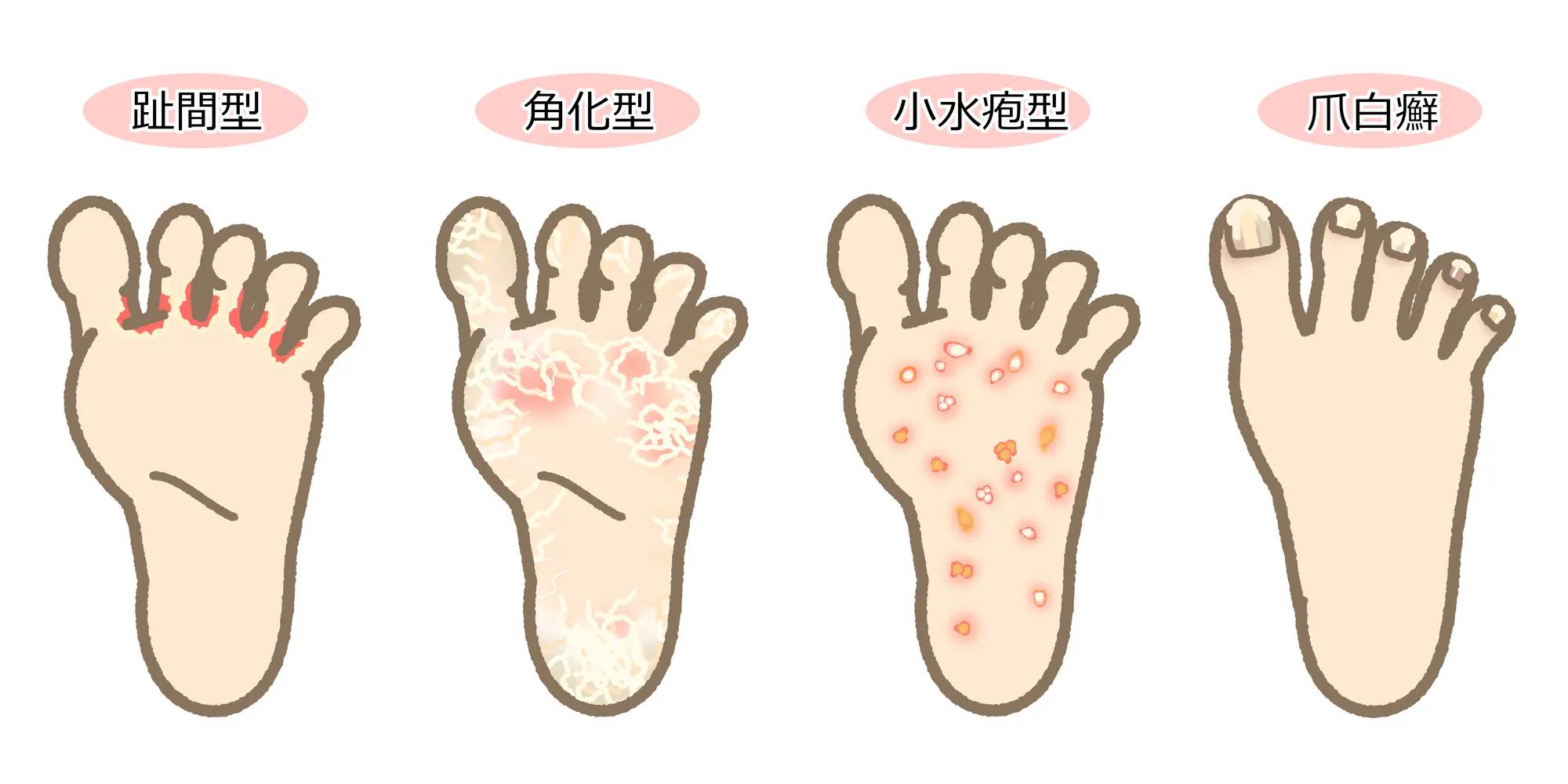 水虫の種類のイラスト図解