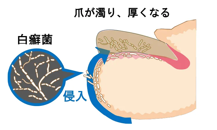 白癬菌が爪に侵入するメカニズムのイラスト