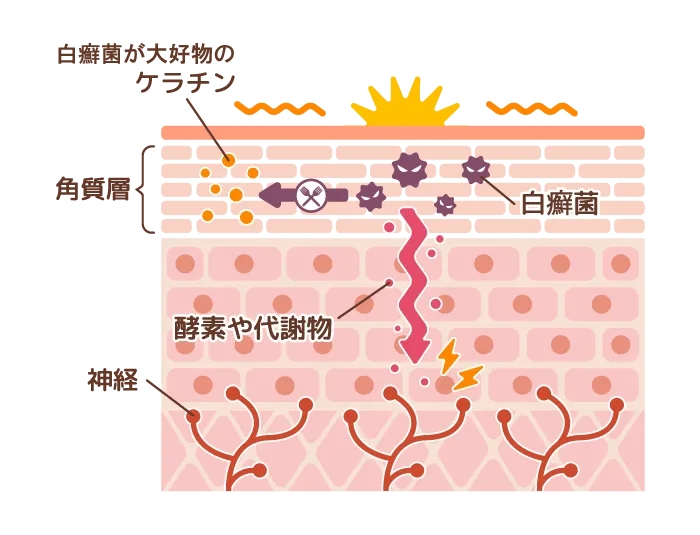爪白癬かゆみのメカニズム