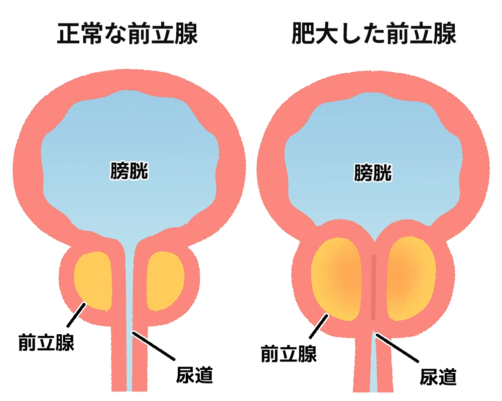 正常な前立腺と肥大した前立腺の比較
