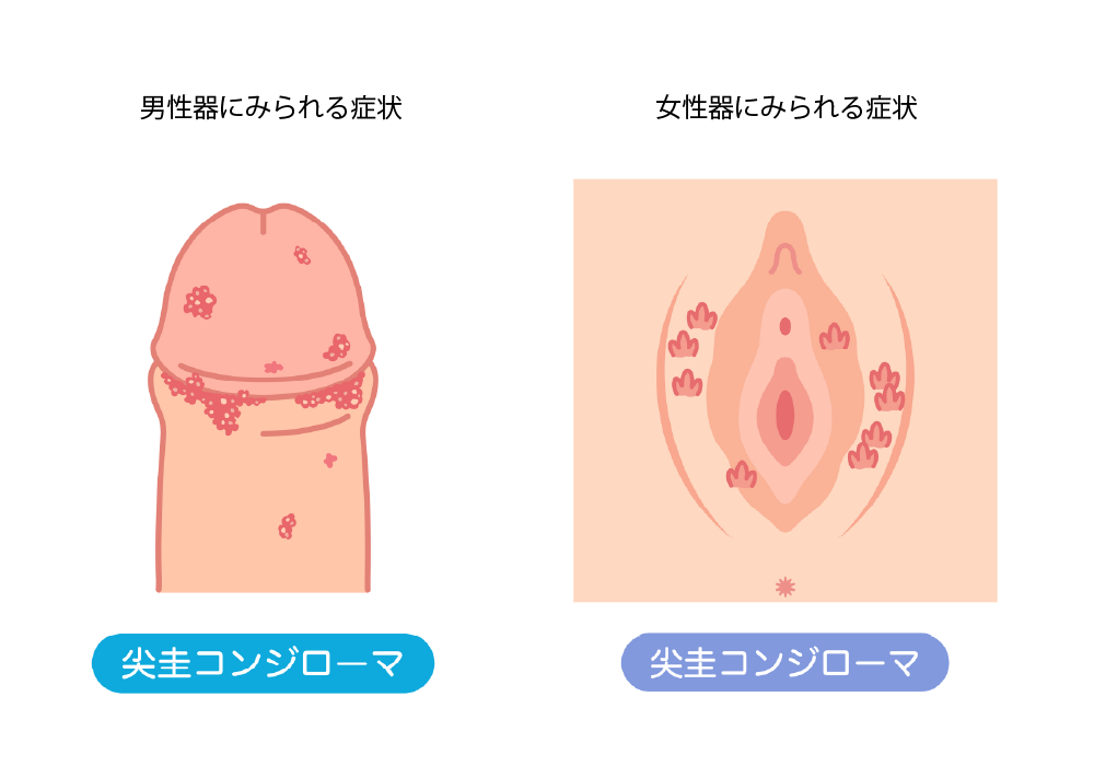 尖圭コンジローマの男性に現れる症状と女性に現れる症状