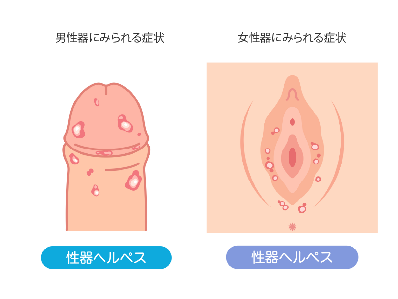 性器ヘルペスの男性に現れる症状と女性に現れる症状