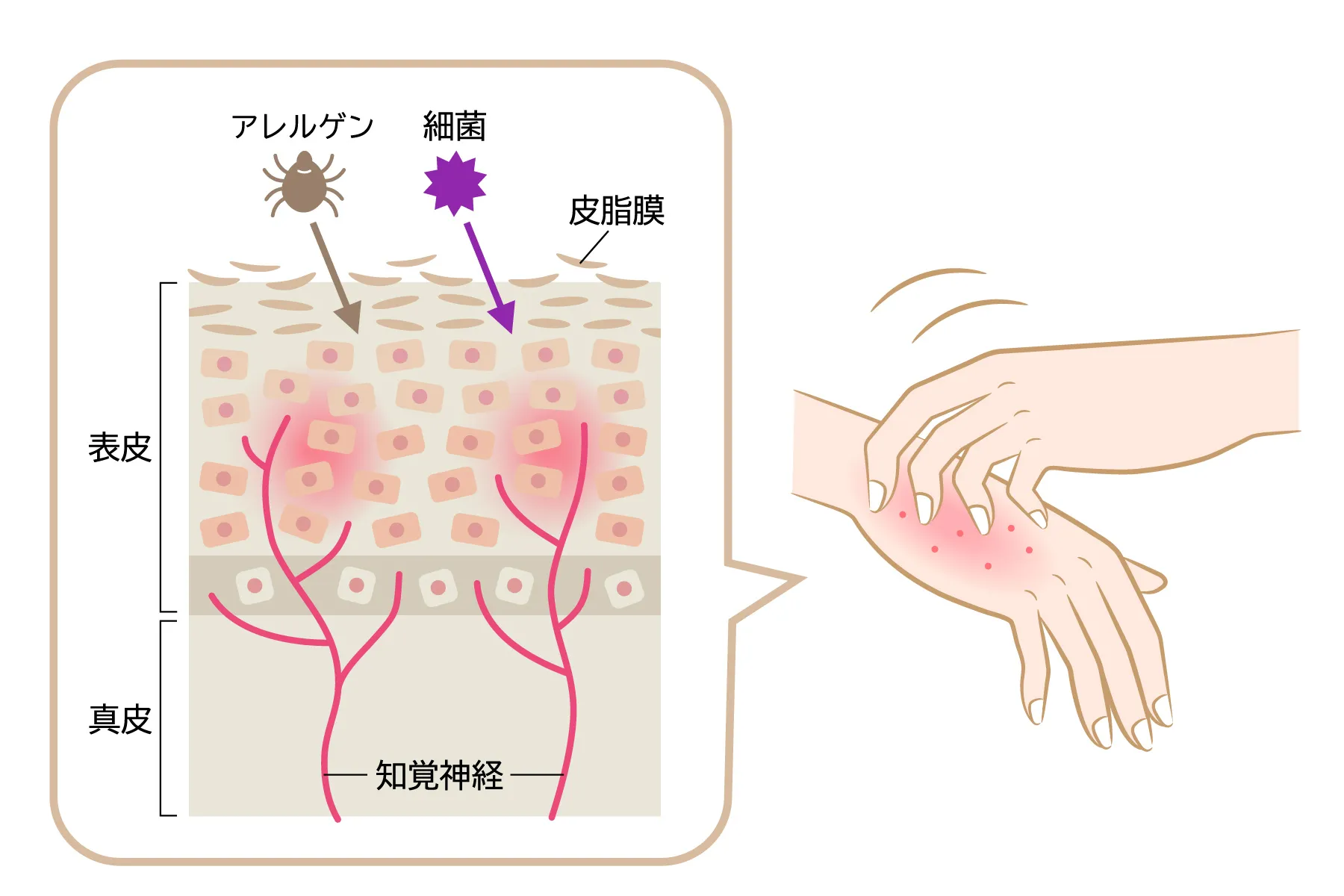 手湿疹がアレルゲンや細菌によって引き起こされるメカニズム