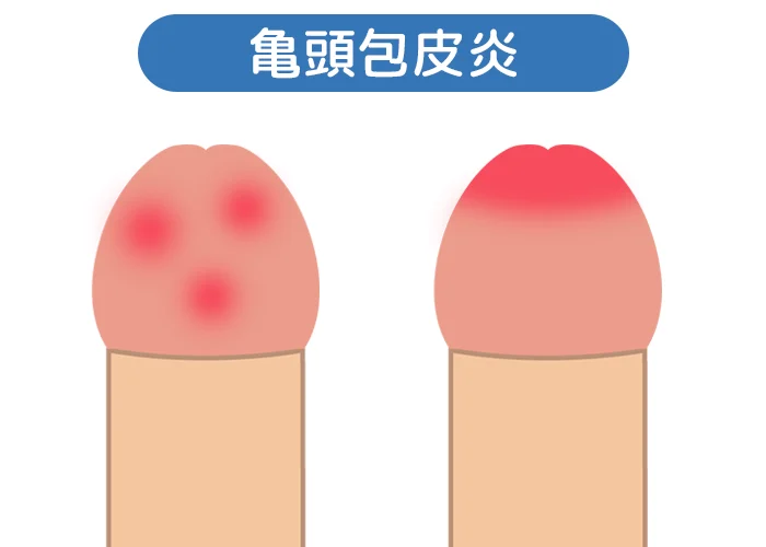 亀頭包皮炎の赤みや腫れ・灼熱感を表すイラスト