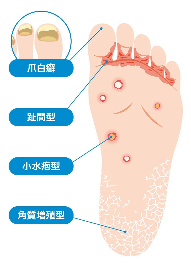 足白癬(水虫)の分類:爪白癬、趾間型、小水疱型、角質増殖型のイラスト