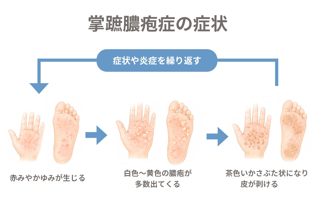 掌蹠膿疱症の手のひらや足の裏に現れる症状