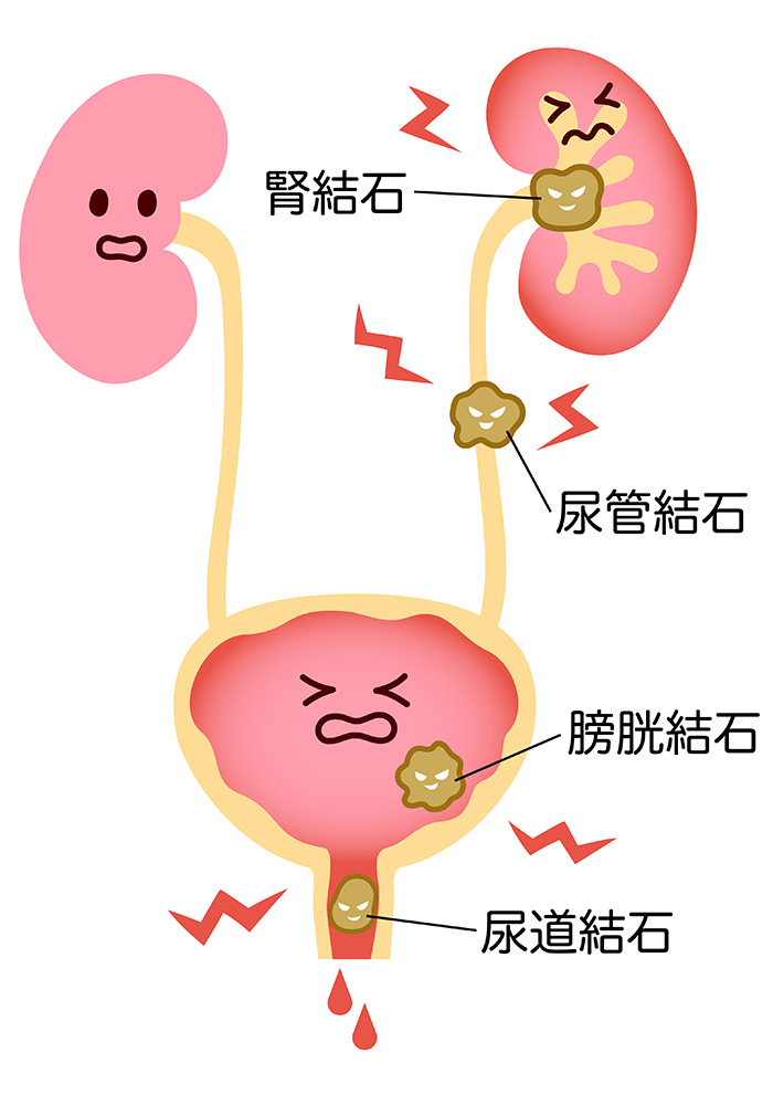 腎結石、尿管結石、膀胱結石、尿道結石等の結石ができる場所の図解