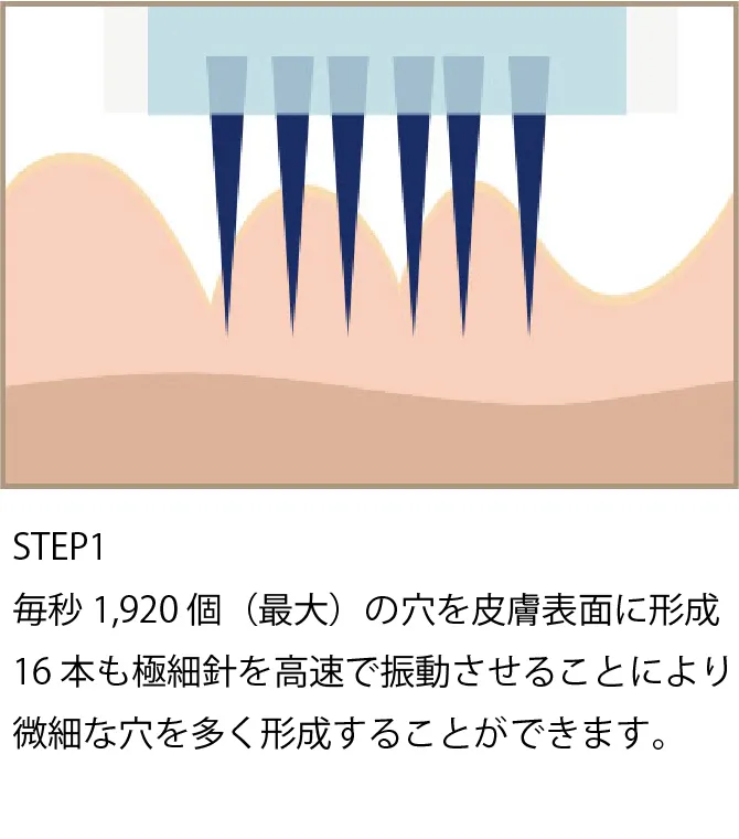 ダーマペン治療ステップ1