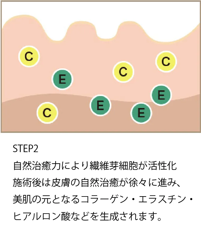 ダーマペン治療ステップ2