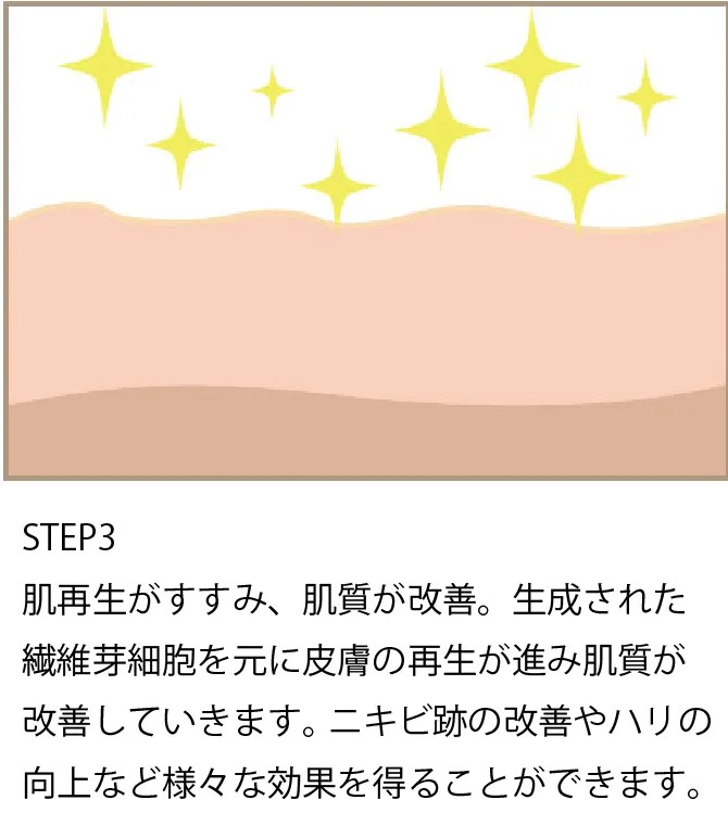 ダーマペン治療ステップ3