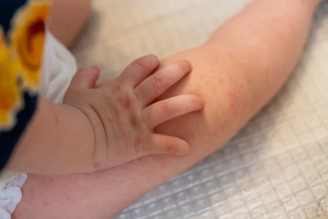 子供の腕や手元に現れた手足口病の赤い発疹