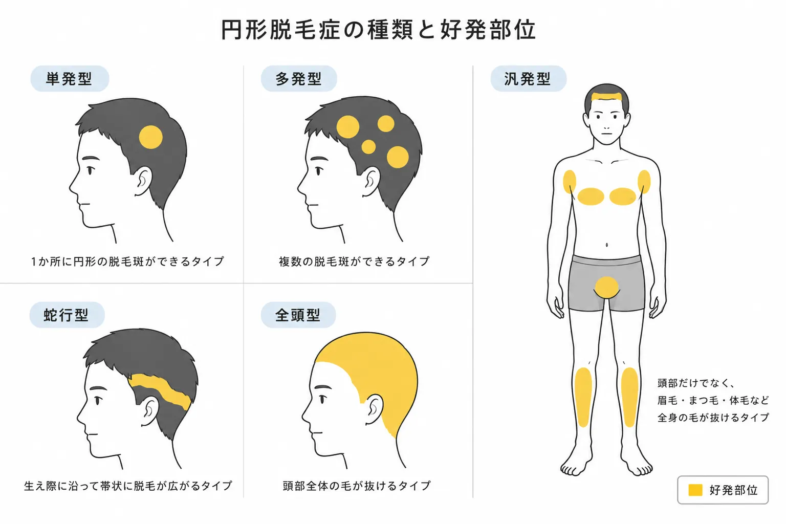 円形脱毛症の種類と好発部位（単発型・多発型・蛇行型・全頭型・汎発型）の図解
