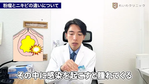 皮膚の中に袋状のものができ角質が溜まる粉瘤の仕組み