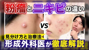 youtubeサムネイル粉瘤とニキビの違い