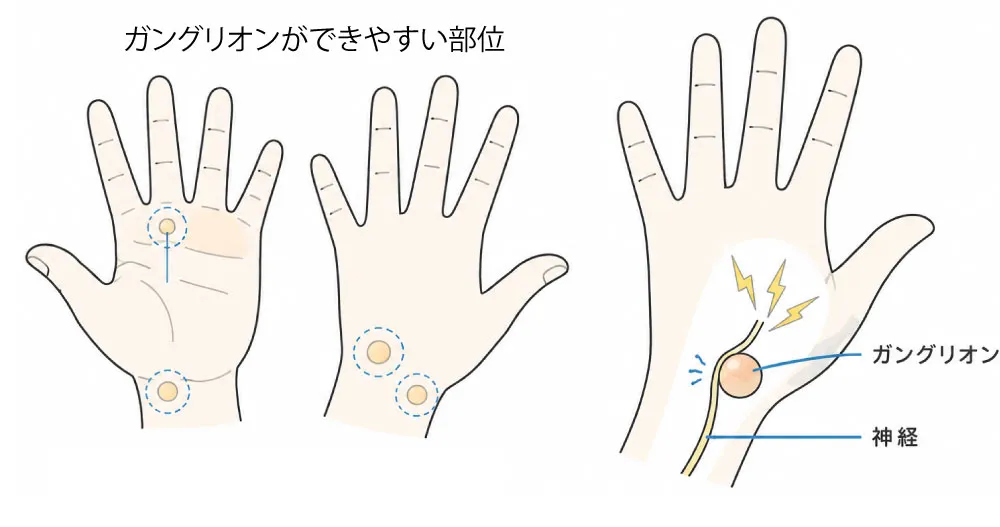 ガングリオンの部位
