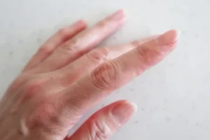 汗疱のイメージ