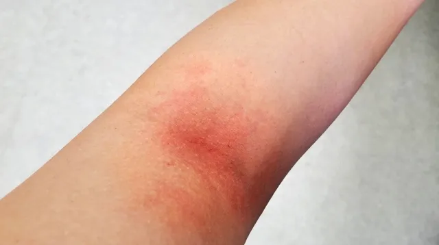 皮膚の赤みとかゆみの症状イメージ
