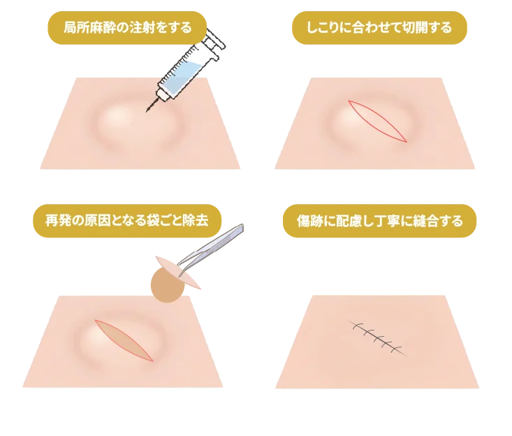 粉瘤の切開術の手順