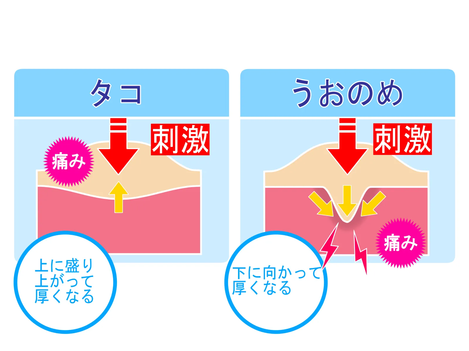 たことうおのめの違いの図解（皮膚の盛り上がり方と芯の深さ）