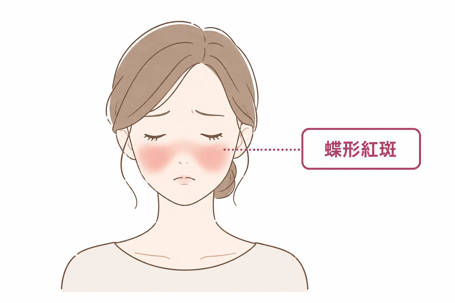 頬部の両側に生じる羽を開いた蝶のような左右対称性の赤い発疹