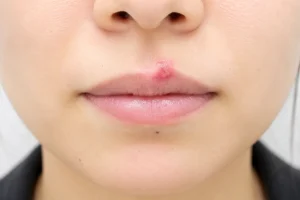 口唇ヘルぺスの症状