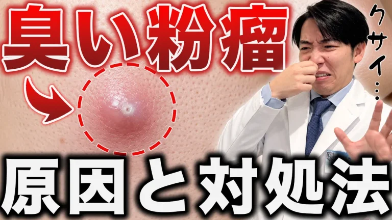 #61_粉瘤は臭い？（サムネイル）