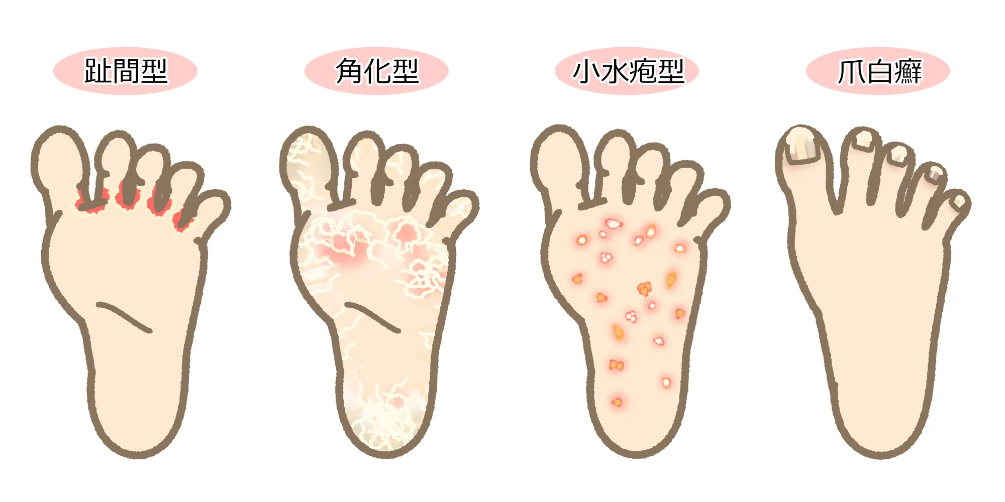  水虫（足白癬）特徴のイラスト図