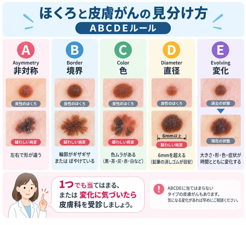 ほくろと皮膚がんの見分け方 ABCDEルール（非対称・境界・色・直径・変化）の図解