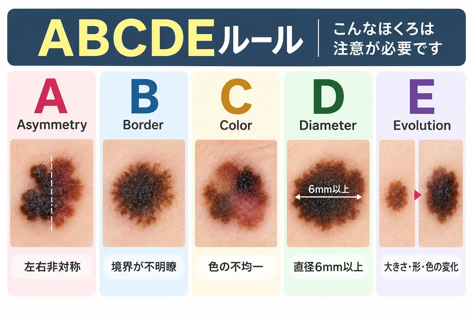 ほくろとメラノーマを見分ける目安となるABCDEルールを解説