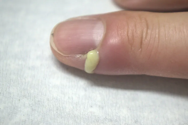 ひょう疽（爪囲炎）の症状：爪の横が赤く腫れて膿が出ている指