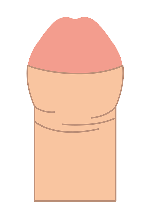 仮性包茎の疾患イメージイラスト