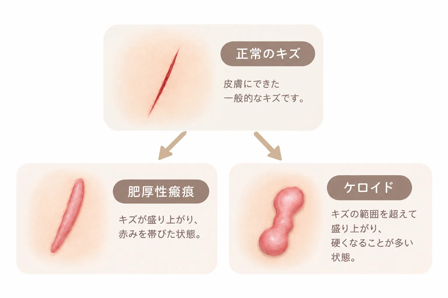正常なキズと肥厚性瘢痕・ケロイドの違いを示すイラスト