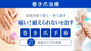巻き爪治療のバナー
