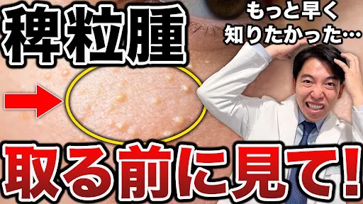 目の周りの白いプツプツについて解説