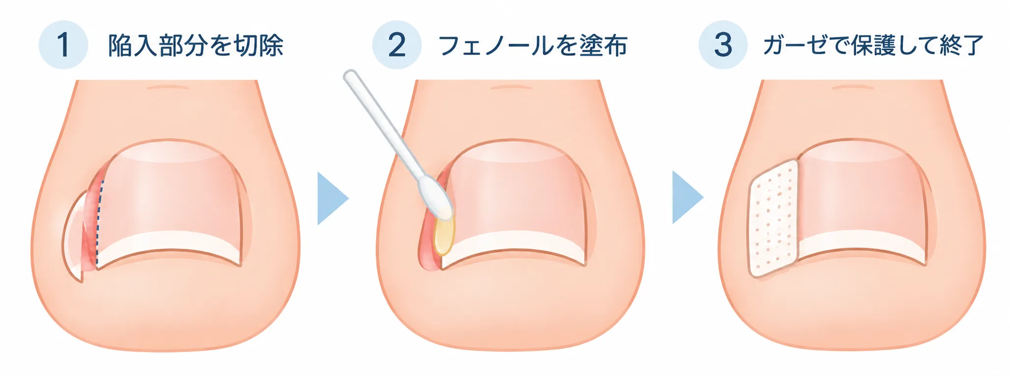 陥入爪のフェノール法による手術の流れ