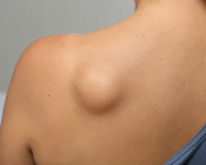 背中にできた脂肪腫