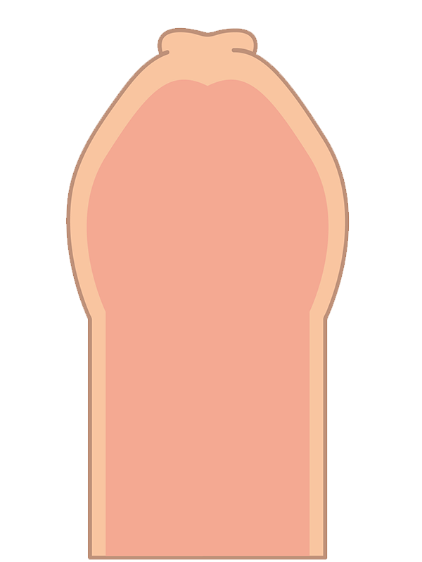 真性包茎の疾患イメージイラスト