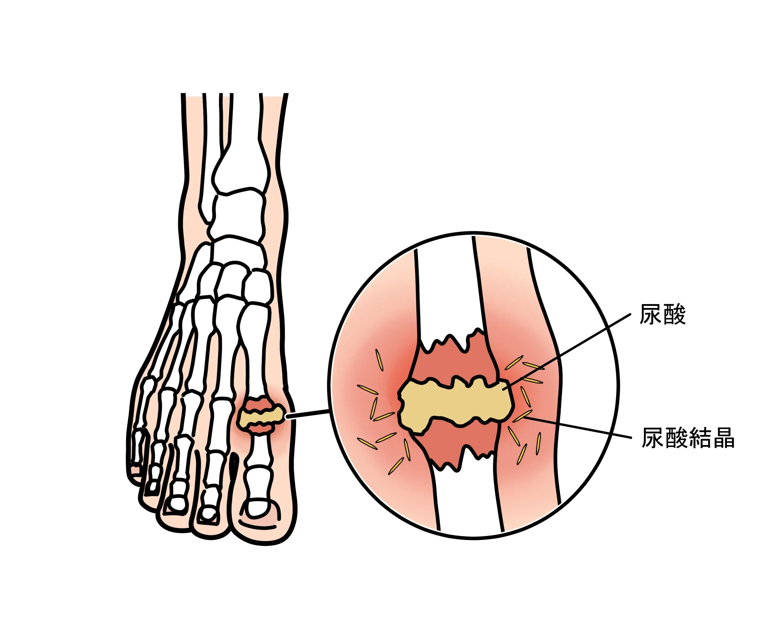 足の親指の付け根に尿酸結晶が沈着して炎症を起こしている様子（痛風のメカニズム）