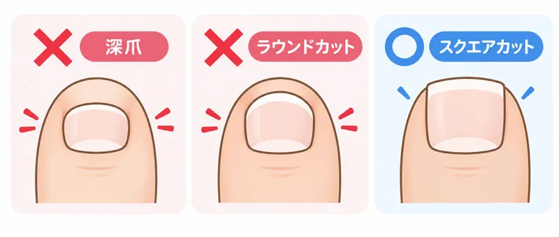 足の爪の正しい切り方（スクエアオフ）と深爪・角の切り落としによる陥入爪のリスク