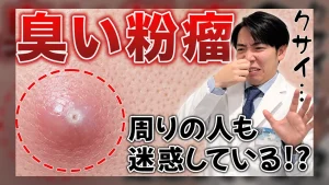 アイキャッチ（粉瘤って臭いですか？）